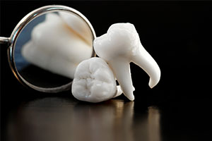 Dental Bonding in Glendale