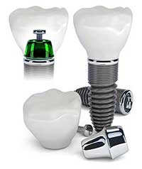 Dental Implants in Glendale