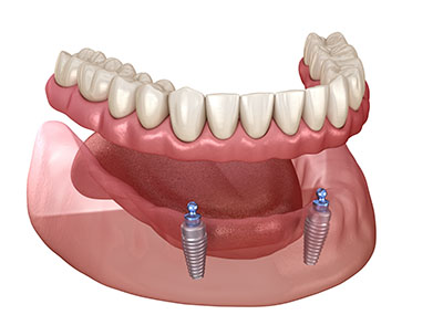 Dental Implants in Glendale