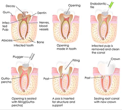 Glendale Root Canal