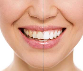 Teeth Whitening in Glendale