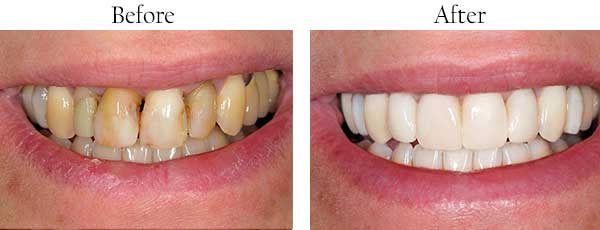Glendale Before and After Dental Implants
