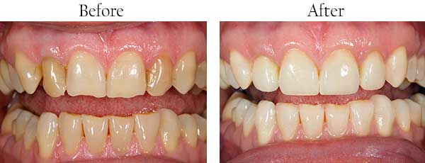 Ridgewood Before and After Teeth Whitening