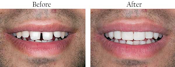 Bushwick Before and After Invisalign