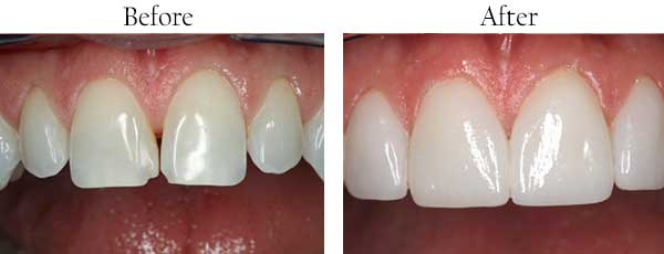 Glendale Before and After Dental Implants