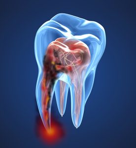 tooth damage xray view