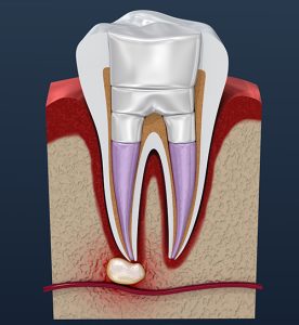 tooth abscess xray view