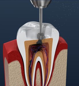 root canal procedure xray view