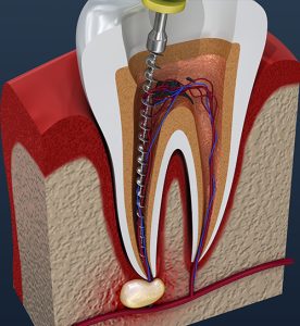 root canal treatmennt xray view