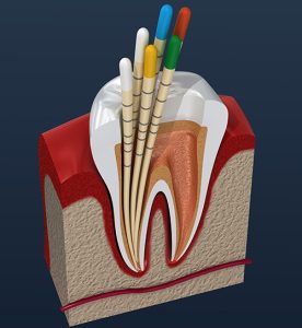 treatment for tooth nerve damage