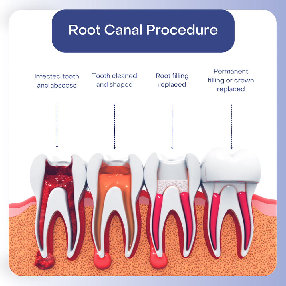 Root Canal Procedure