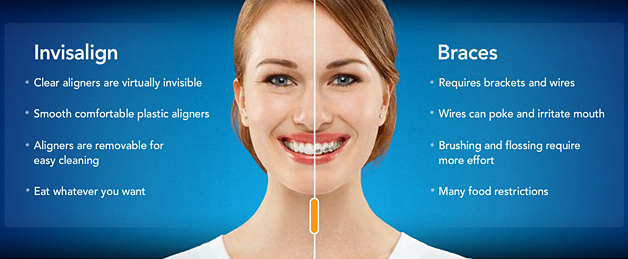 Invisalign Comparison Chart