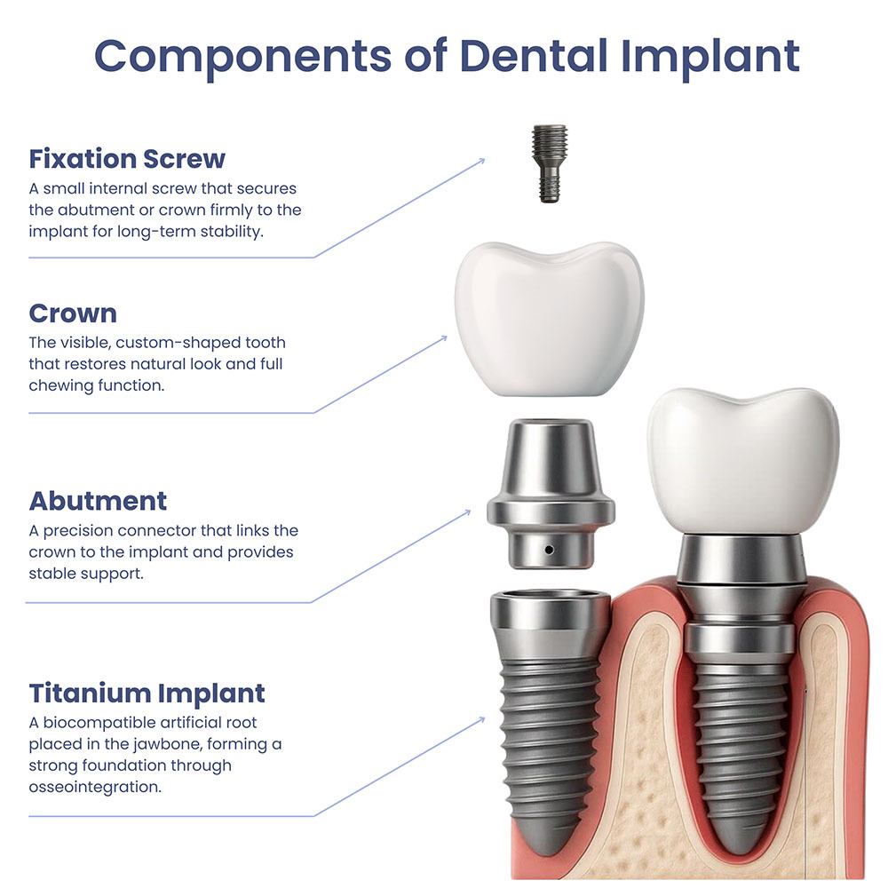 Components of Dental Implant