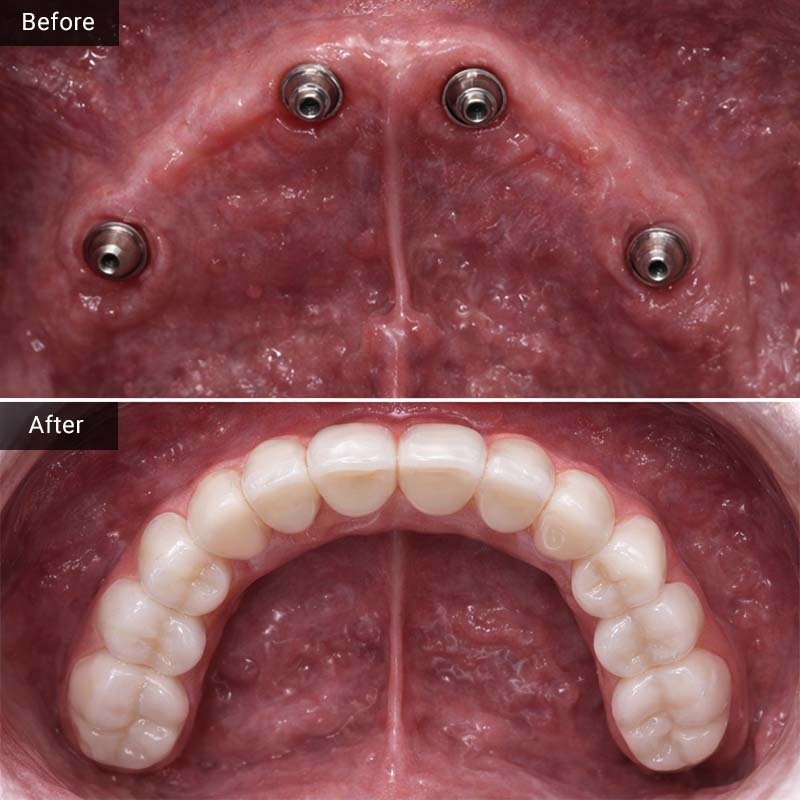 All-on-4 Dental Implants Glendale, NY