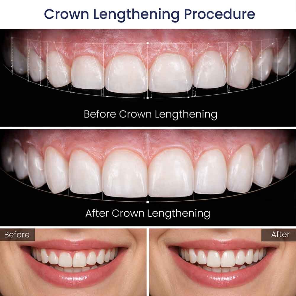 Atlas Park Dental Crown Lengthening Before After Glendale NY