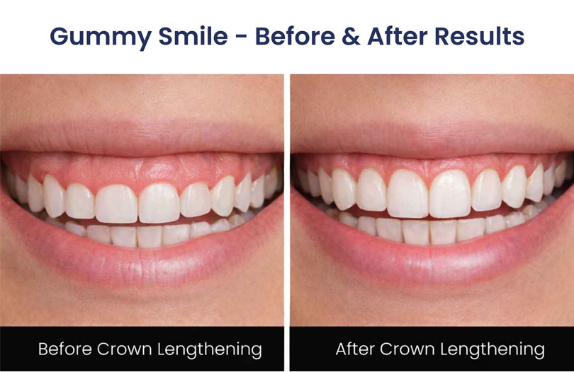 Atlas Park Dental Gummy Smile Crown Lengthening Before After Glendale NY