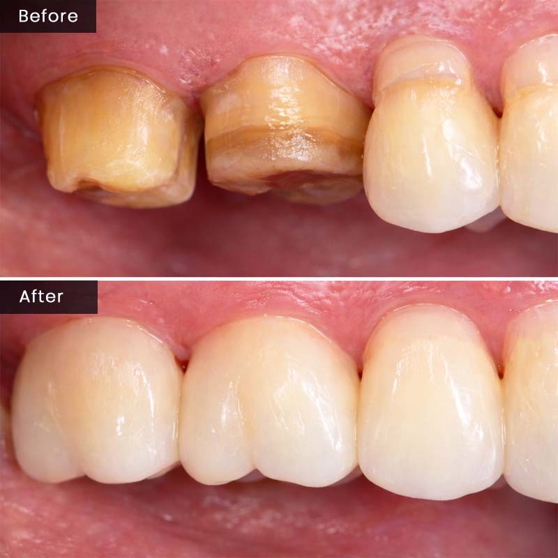 Before and After Porcelain Crowns Restoration Glendale, NY