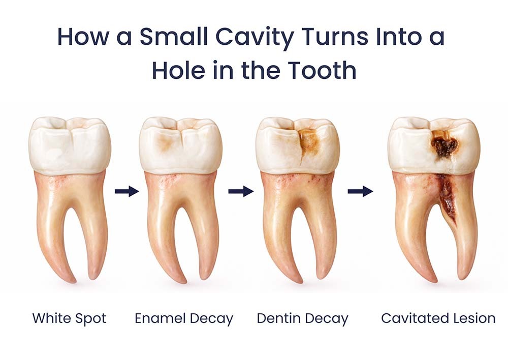Cavity Progression to Hole in Tooth Stages