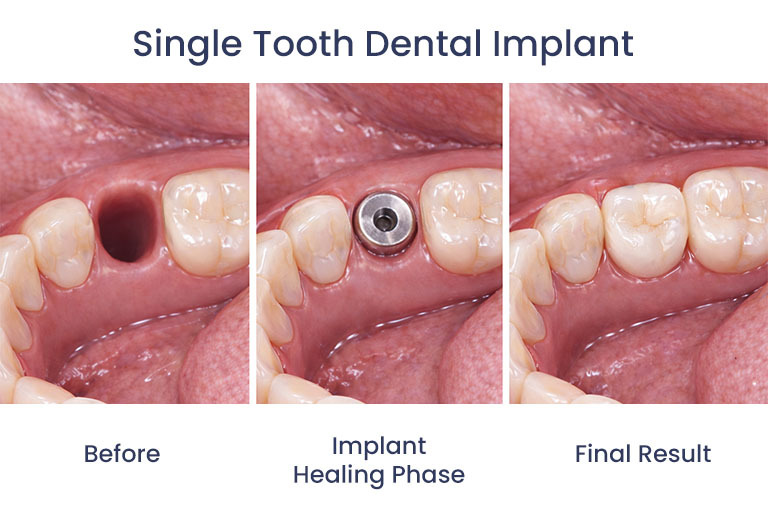 Dental Implant Before After Single Tooth Glendale, NY Atlas Park Dental