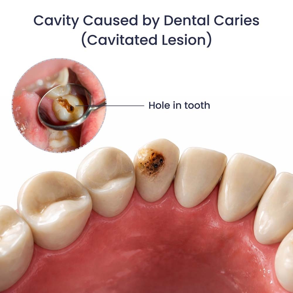 Hole in Tooth Dental Caries Lesion
