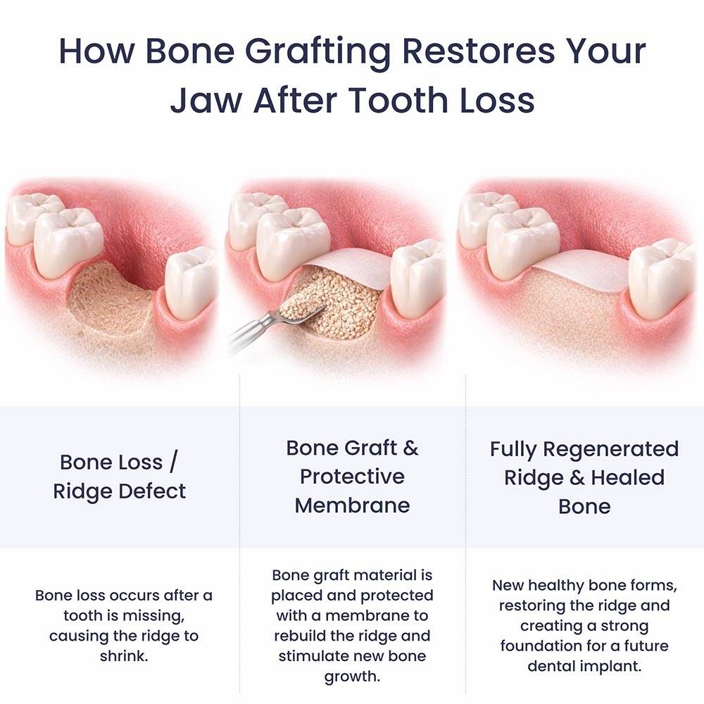 How Bone Grafting Restores The Jawbone After Tooth Loss