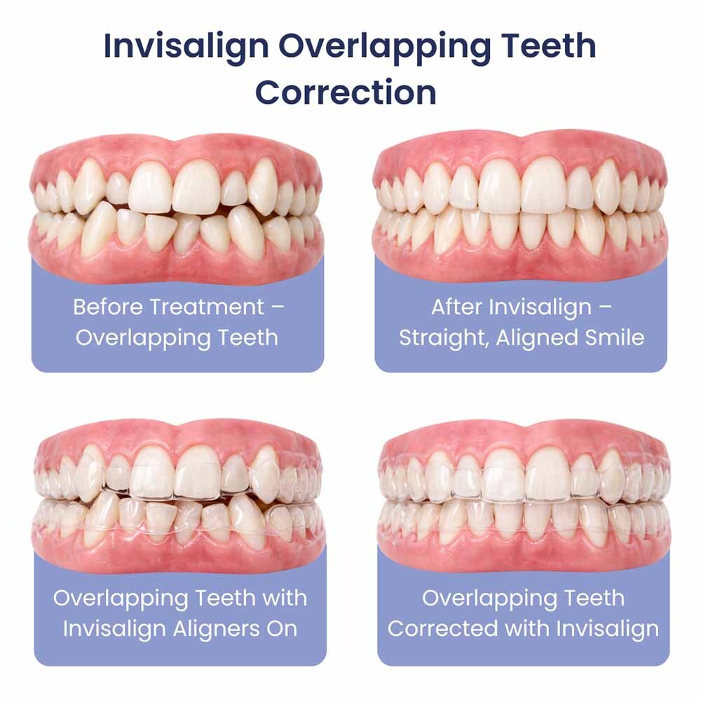 Invisalign Overcrowded Overlapping Teeth Correction Glendale, NY