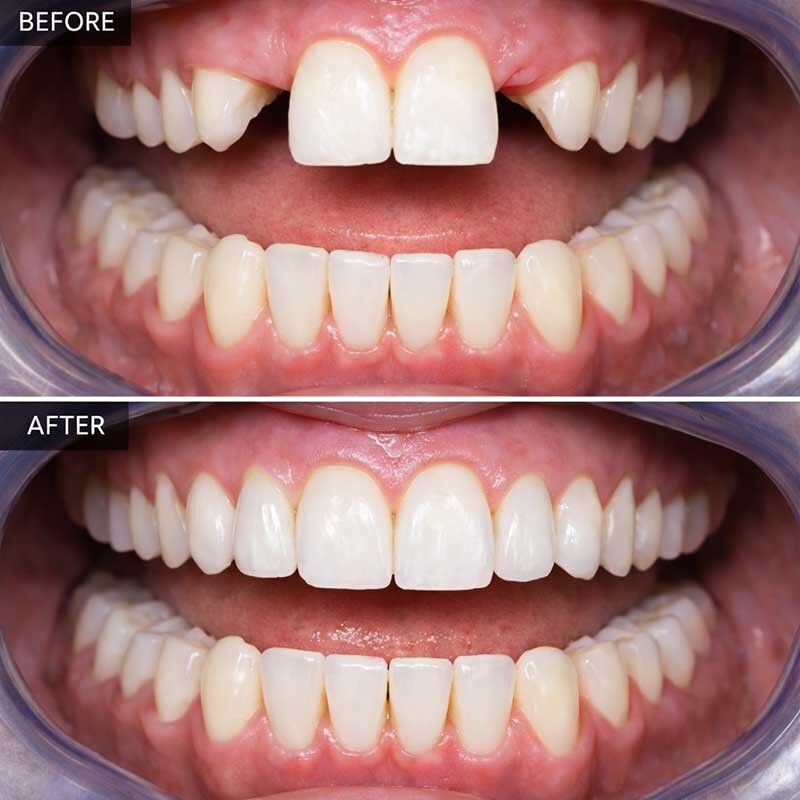 Mini Dental Implants Before After Glendale, NY