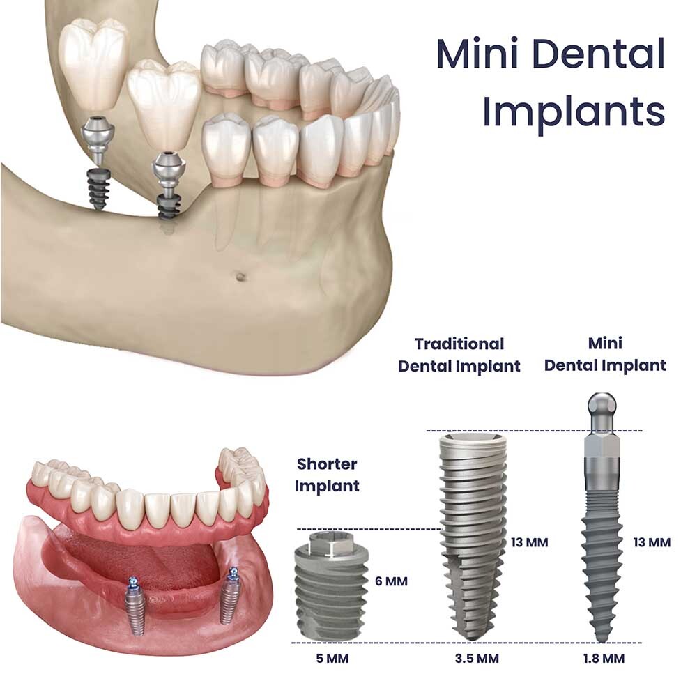 Mini Dental Implants Glendale, NY