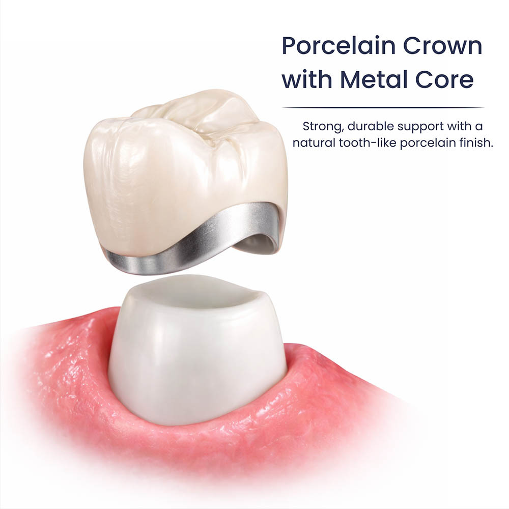 Porcelain Crown With Metal Core Glendale, NY
