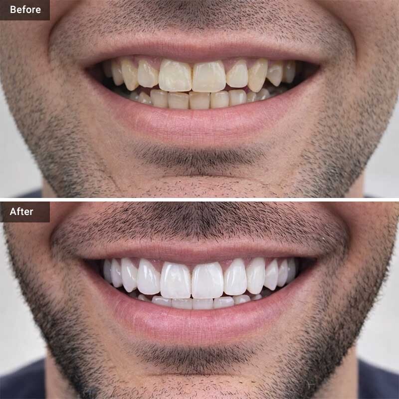 Porcelain Veneers Before After Smile Transformation Glendale, NY