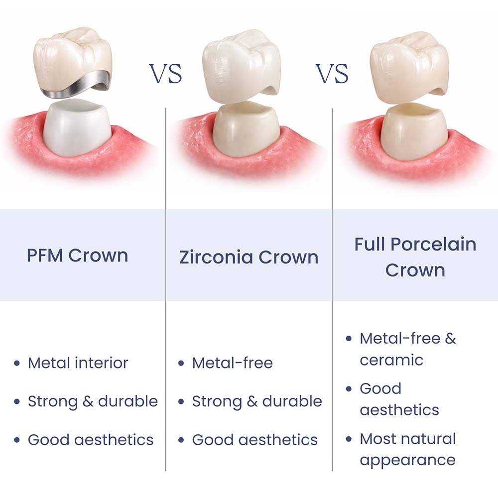 Porcelain vs Zirconia vs PFM Dental Crown Comparison