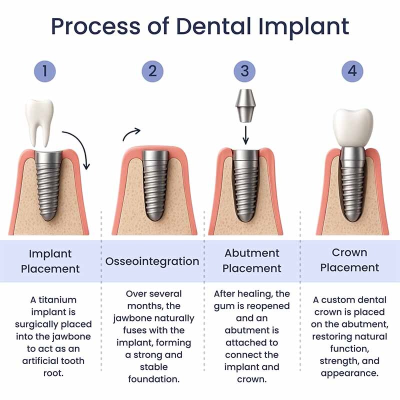 Process of Dental Implant Glendale, NY