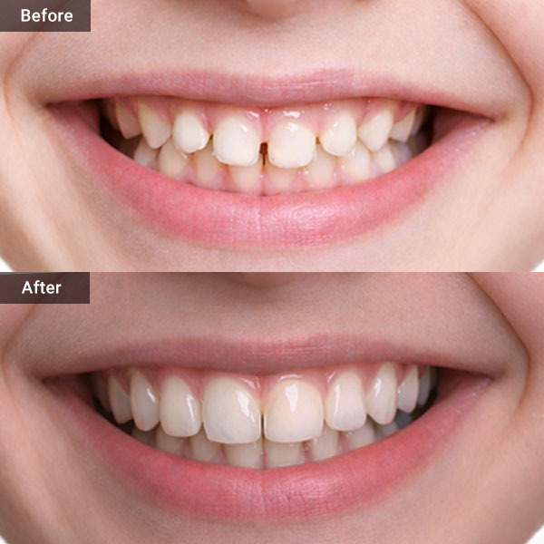 Small Teeth Microdontia Before and After Glendale, NY