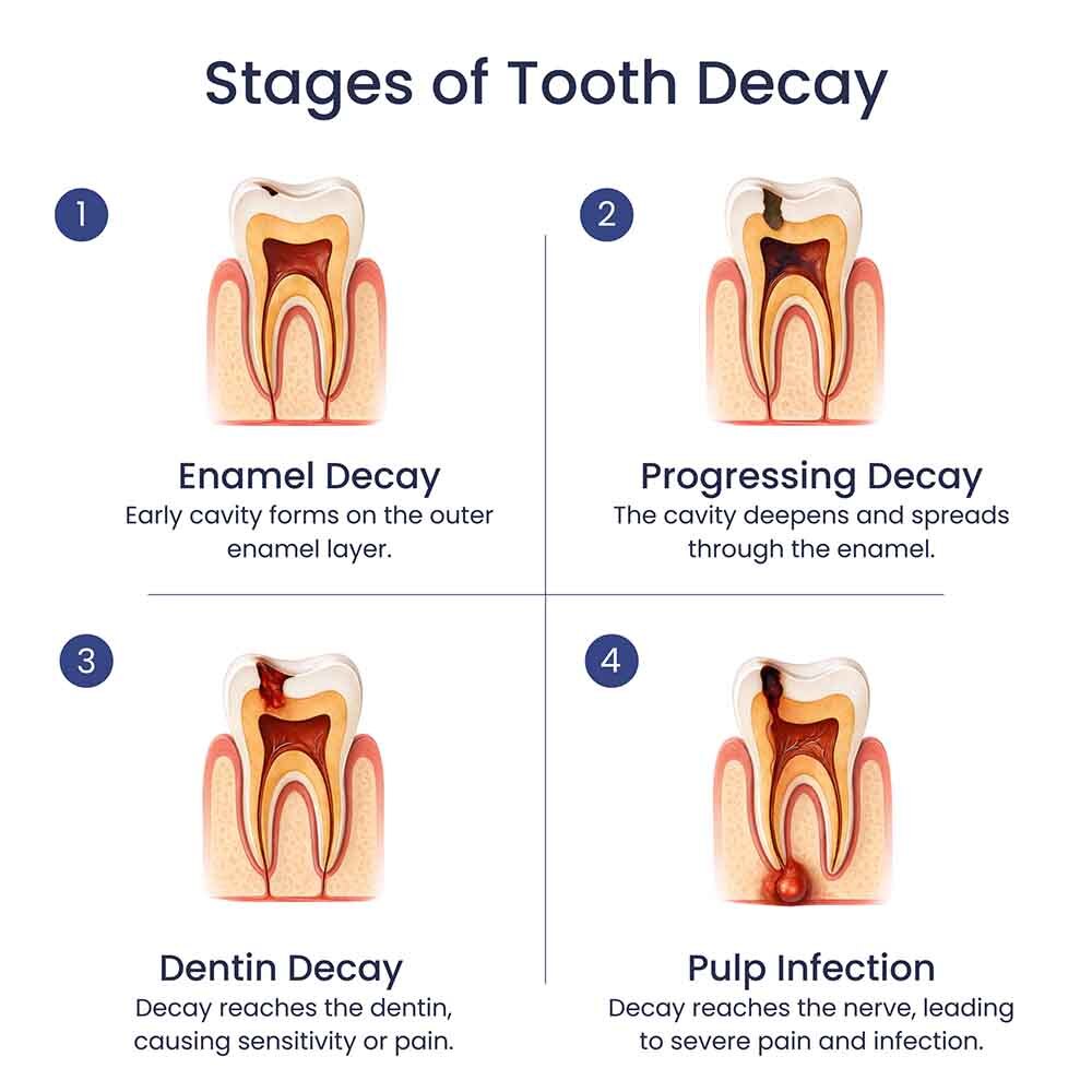 Stages of Tooth Decay