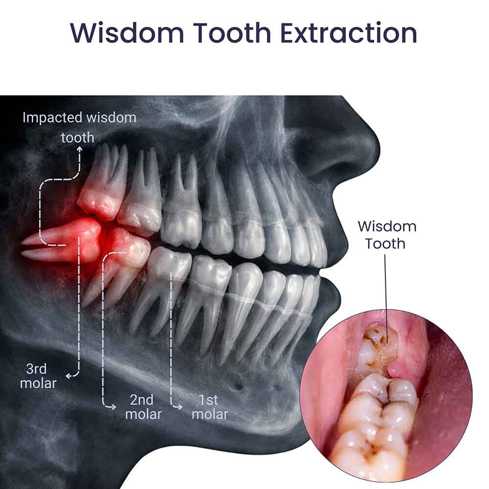 Wisdom Teeth Extraction Glendale, NY