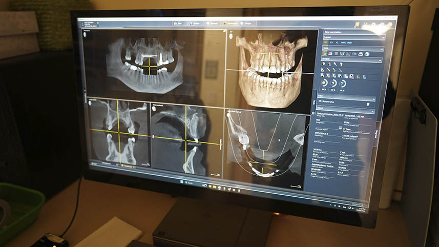 3D CBCT scan used by Atlas Park Dental in Glendale, Queens to digitally plan precise zirconia crowns and evaluate jawbone, roots, and bite alignment