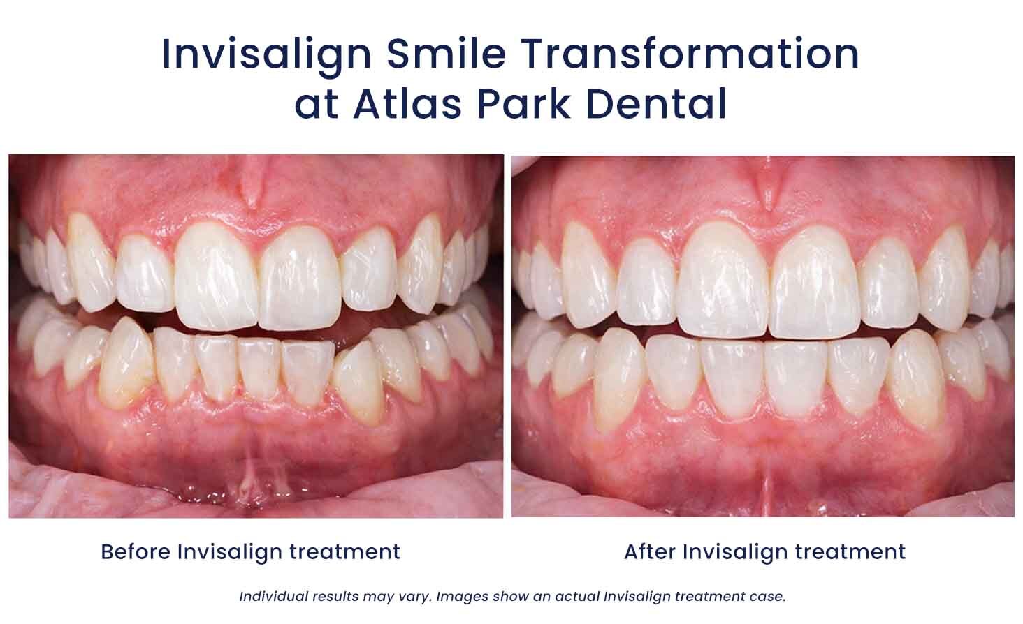 Atlas Park Dental Invisalign Smile Transformation Before After