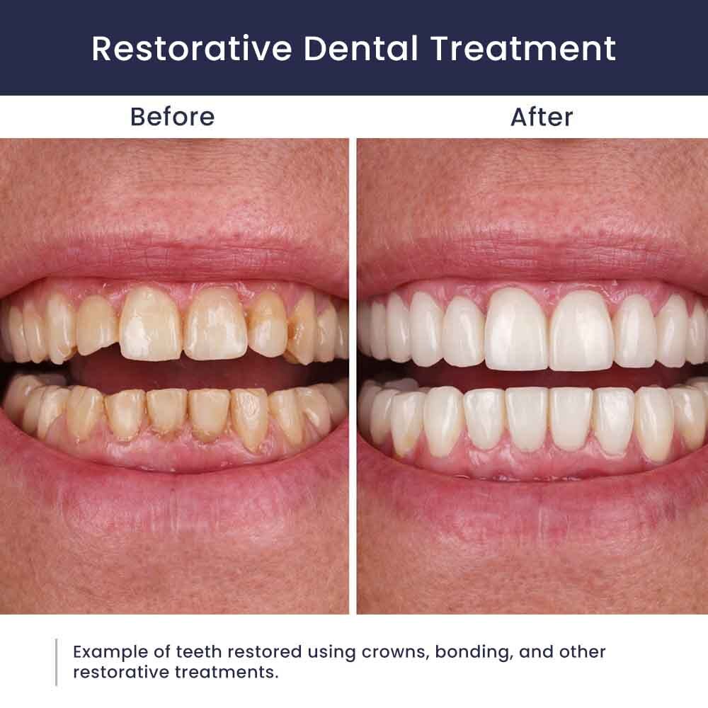 Atlas Park Dental Restorative Dentistry Before After Teeth Restoration