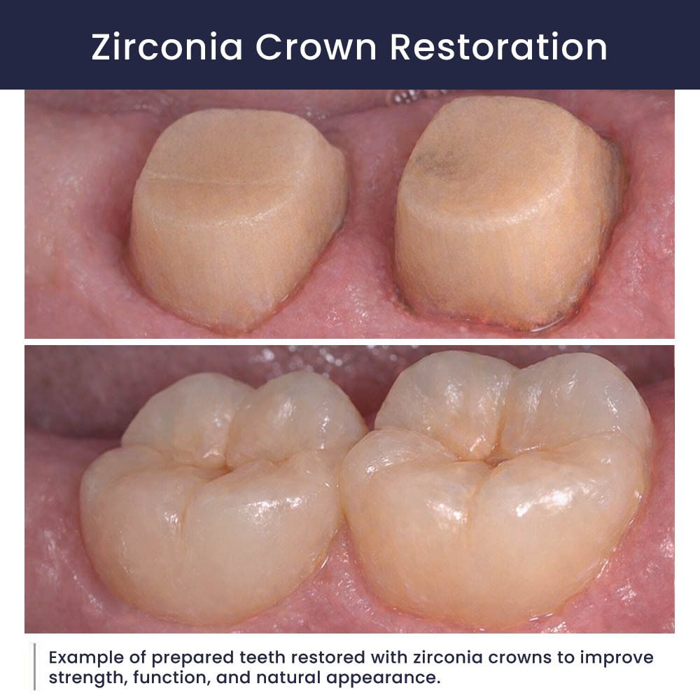 Atlas Park Dental Zirconia Crown Restoration Before After