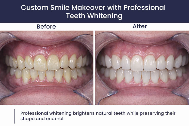 Custom Smile Makeover Professional Teeth Whitening