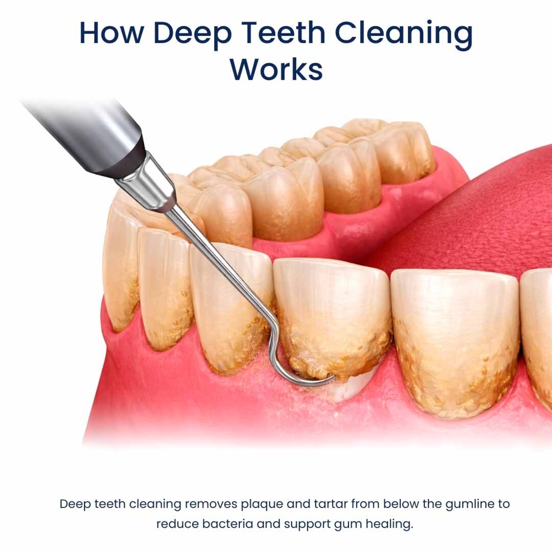 illustration of deep teeth cleaning showing scaling and root planing removing plaque and tartar from below the gumline