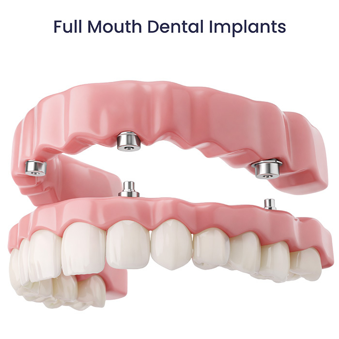 illustration showing a full mouth dental implant-supported arch with abutments and implant placement in the jawbone.
