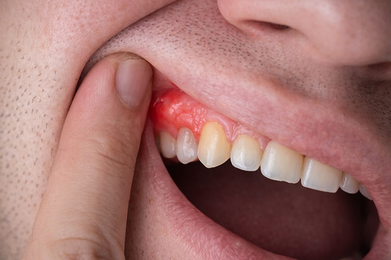 Swollen gum tissue caused by a tooth infection near the affected tooth