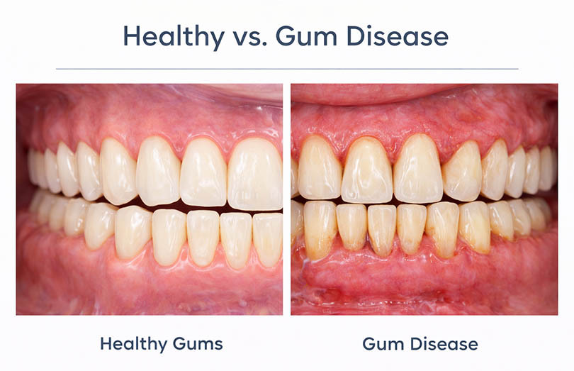 Gum Disease Receding Gums Abscess Infection Treatment In Glendale 