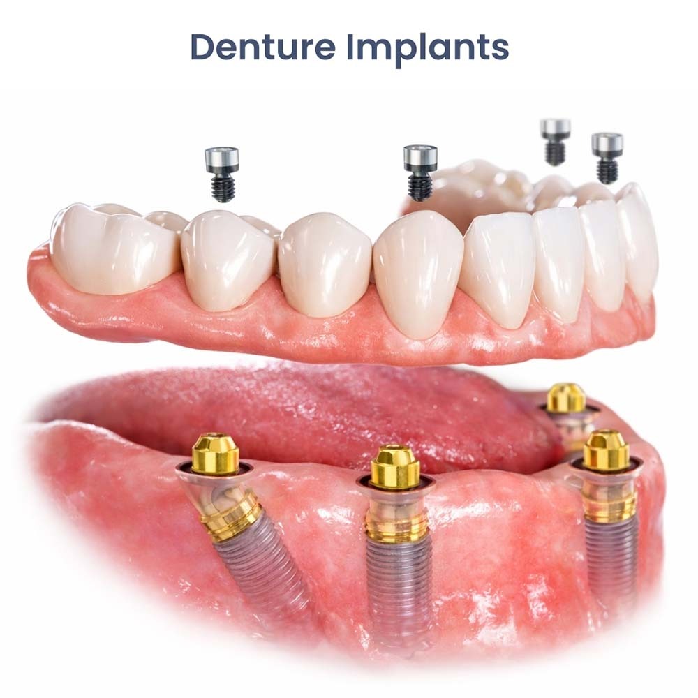 3D illustration of implant supported snap-in dentures attached to dental implants at Atlas Park Dental in Glendale, Queens, showing how denture implants securely lock into place