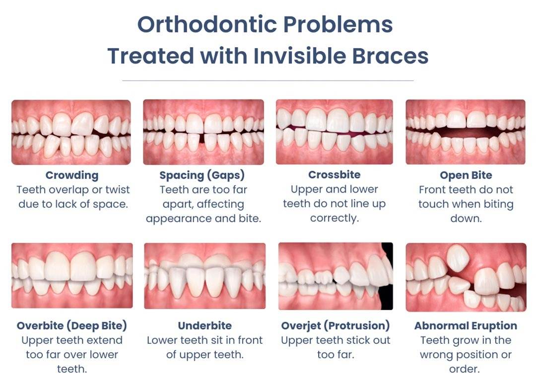 Orthodontic Problems Treated With Invisible Braces Atlas Park Dental Glendale Queens