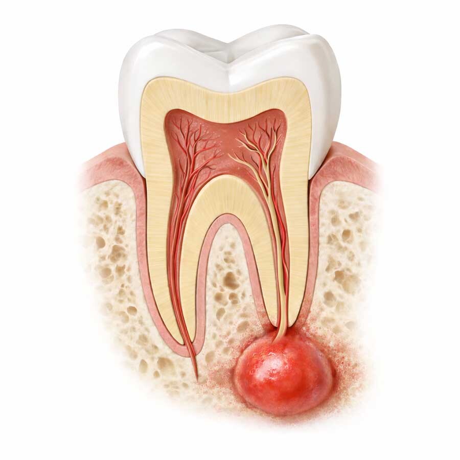 Illustration showing a periapical tooth abscess forming at the root of an infected tooth