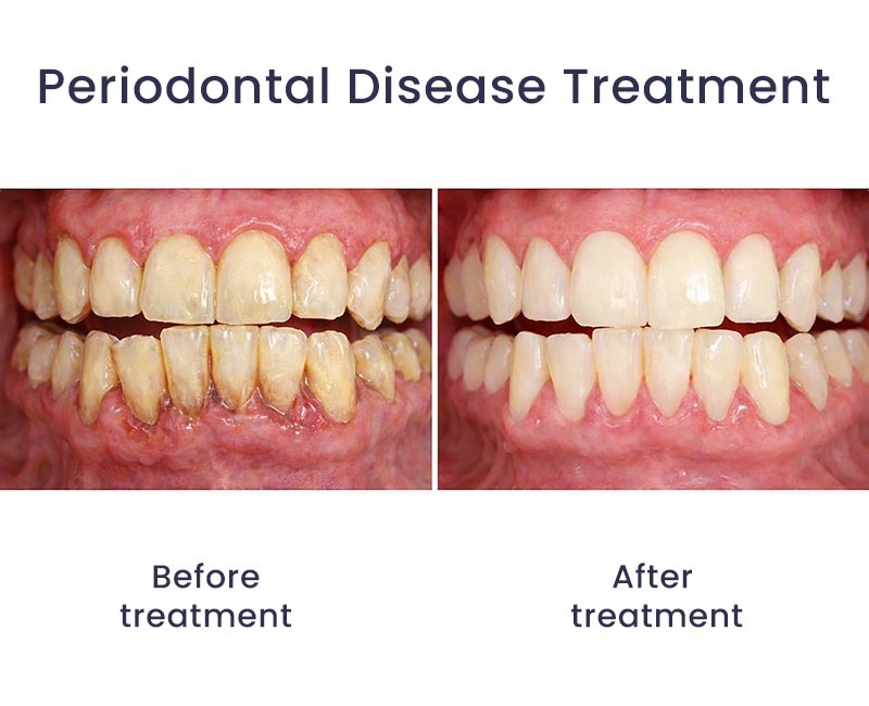 Periodontal Disease Treatment Before After Glendale, NY 11385