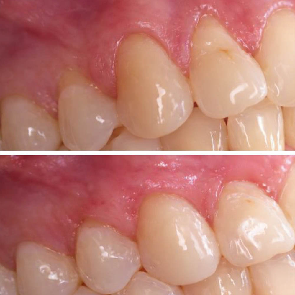 Before and after results of pinhole surgery showing correction of gum recession and improved gumline appearance