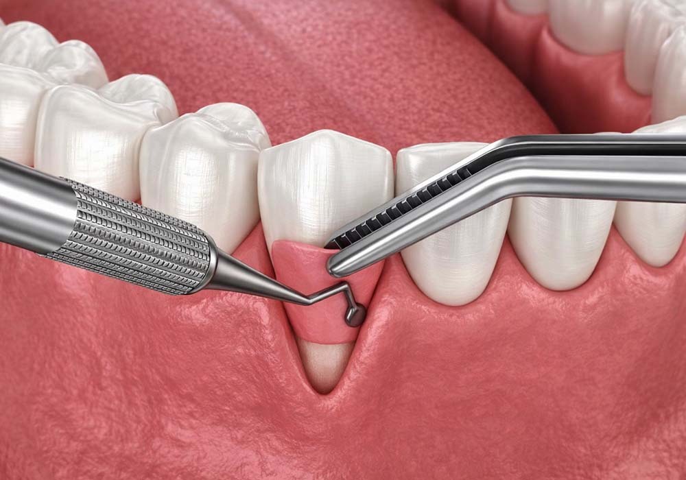 Pinhole surgical technique used to treat gum recession by repositioning gum tissue without traditional grafting